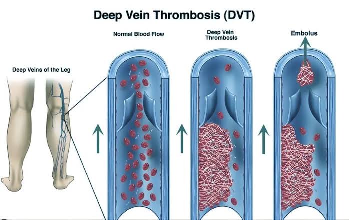 Deep Vein Thrombosis Deep Vein Thrombosis